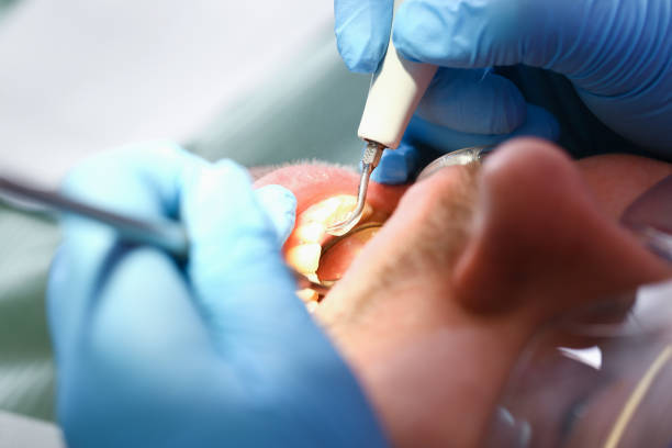 Best Emergency Wisdom Teeth Removal in Fremont, OH